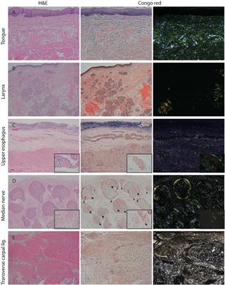 Unique Phenotypes With Corresponding Pathology in Late-Onset Hereditary Transthyretin Amyloidosis of A97S vs. V30M